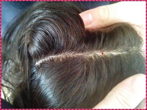 Nốt ruồi trên đầu mang ý nghĩa gì?