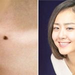 Nốt ruồi ở chỗ kín nói lên điều gì?